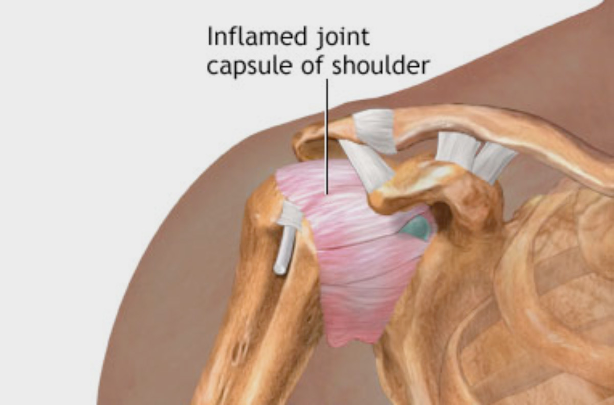 What Is A Frozen Shoulder Pro Active